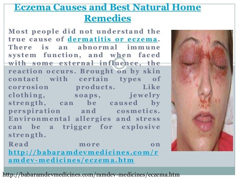 Eczema causes and best natural home remedies