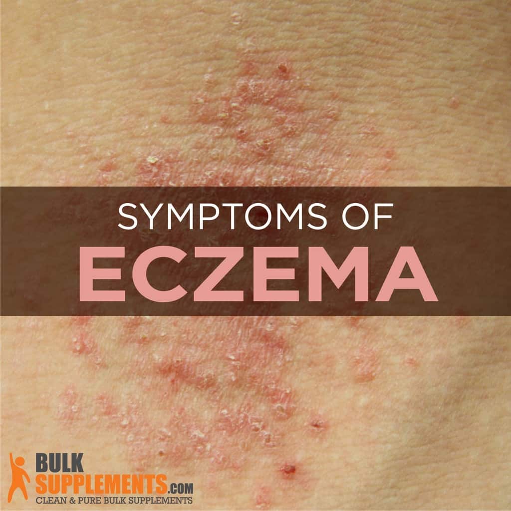 Eczema: Characteristics, Causes &  Treatment