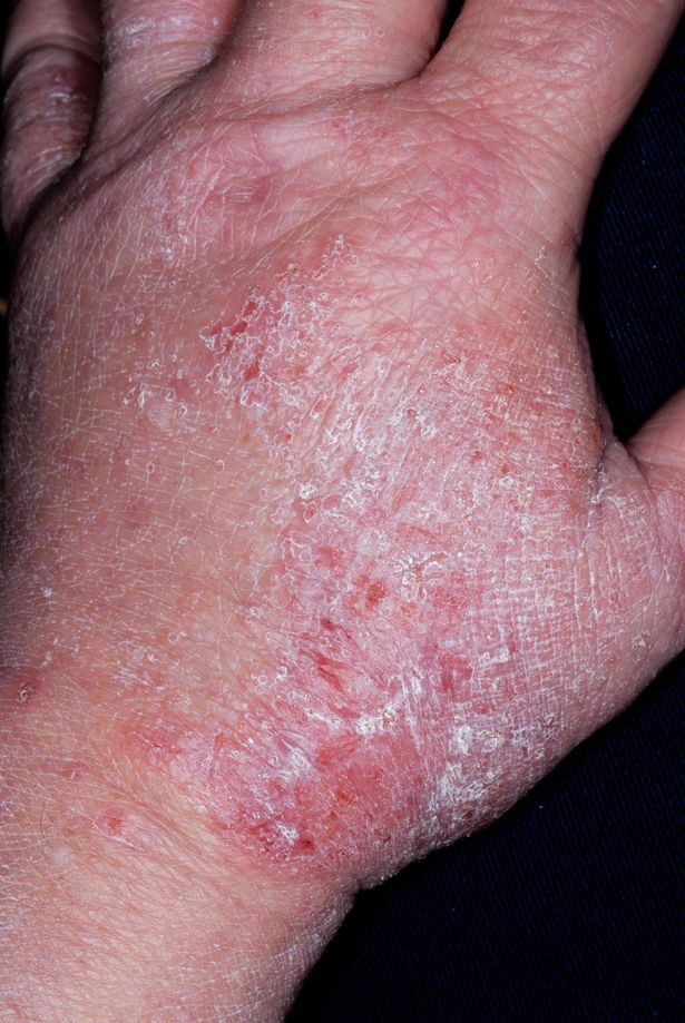 Eczema could be the cause of sleeping problems among children, new ...