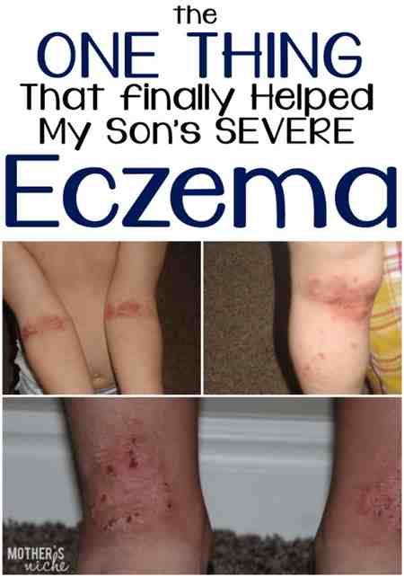 Eczema Cream Under Eyes Is Blistering