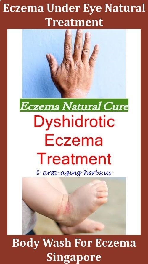 Eczema Cure Treatment Do I Have Eczema Taltz Eczema Foods ...