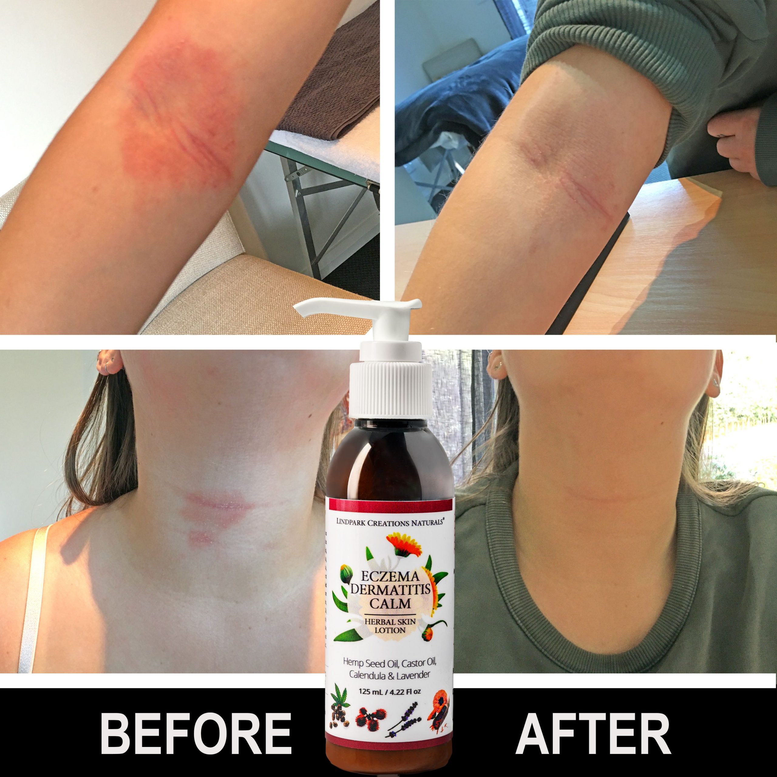 Eczema Dermatitis Calm Lotion: Hemp Seed, Castor Oil ...