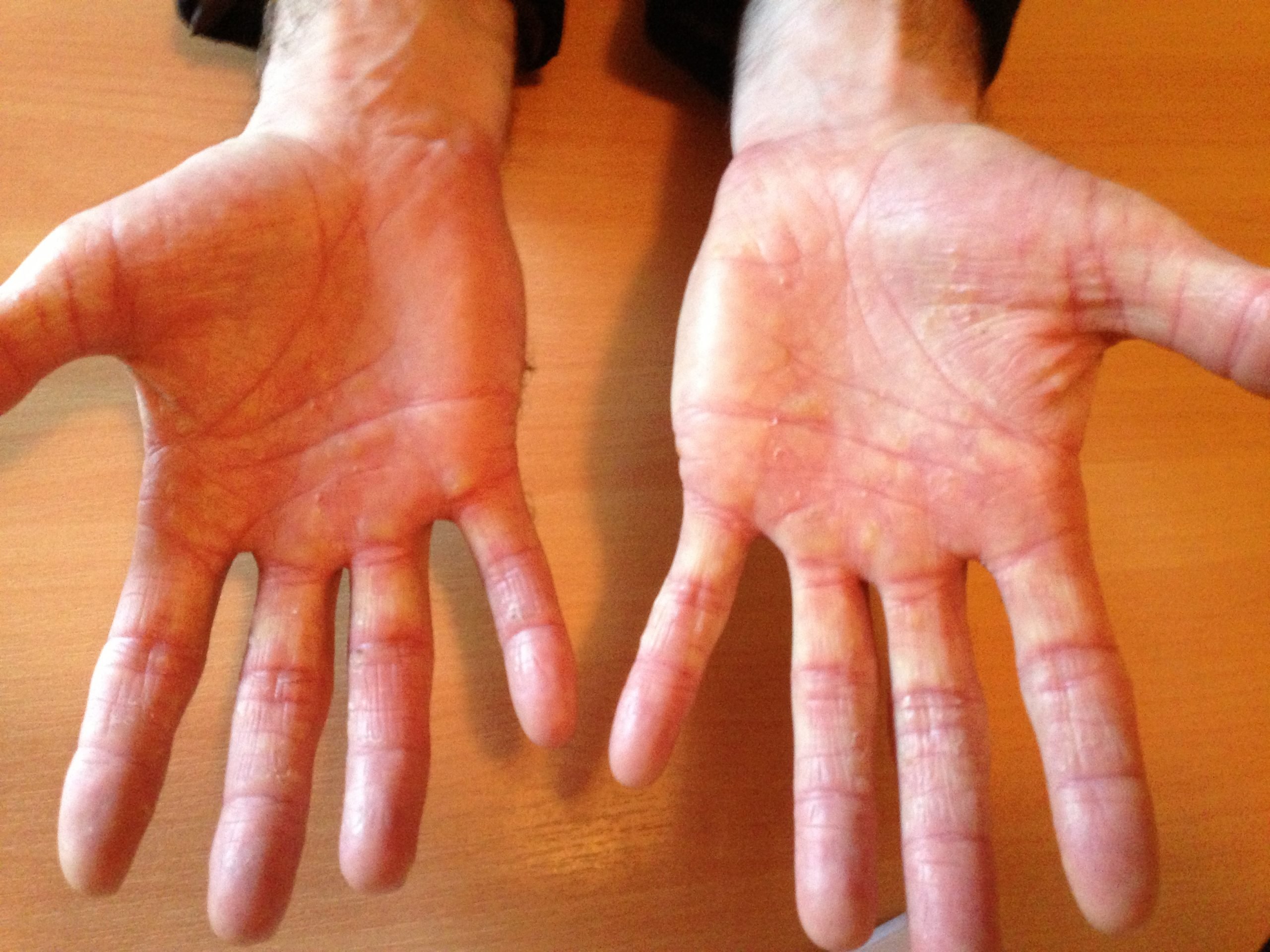 eczema dry itchy skin dermatitis hands