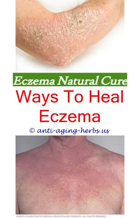 eczema: Eczema Behind Ears Treatment
