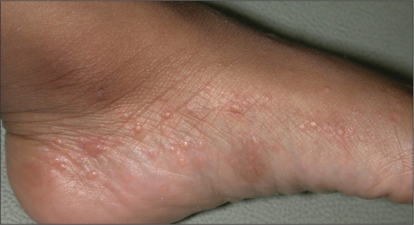 eczema: Eczema Palms And Feet
