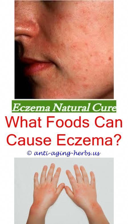 eczema: Eczema Rash On Back Of Neck