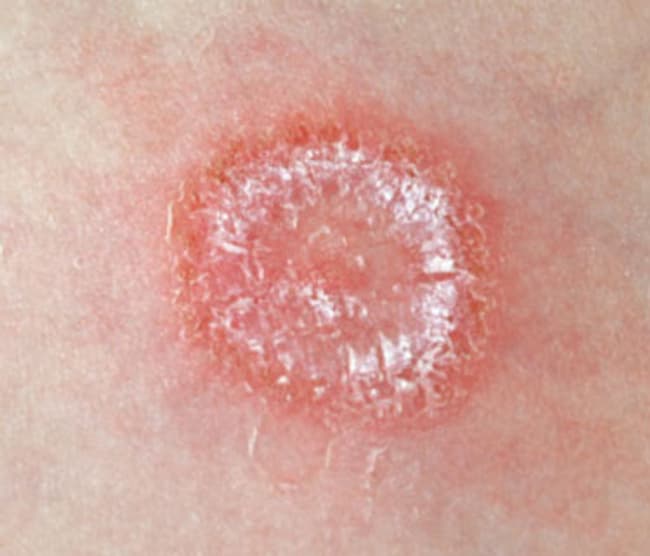 eczema: eczema vs ringworm pictures
