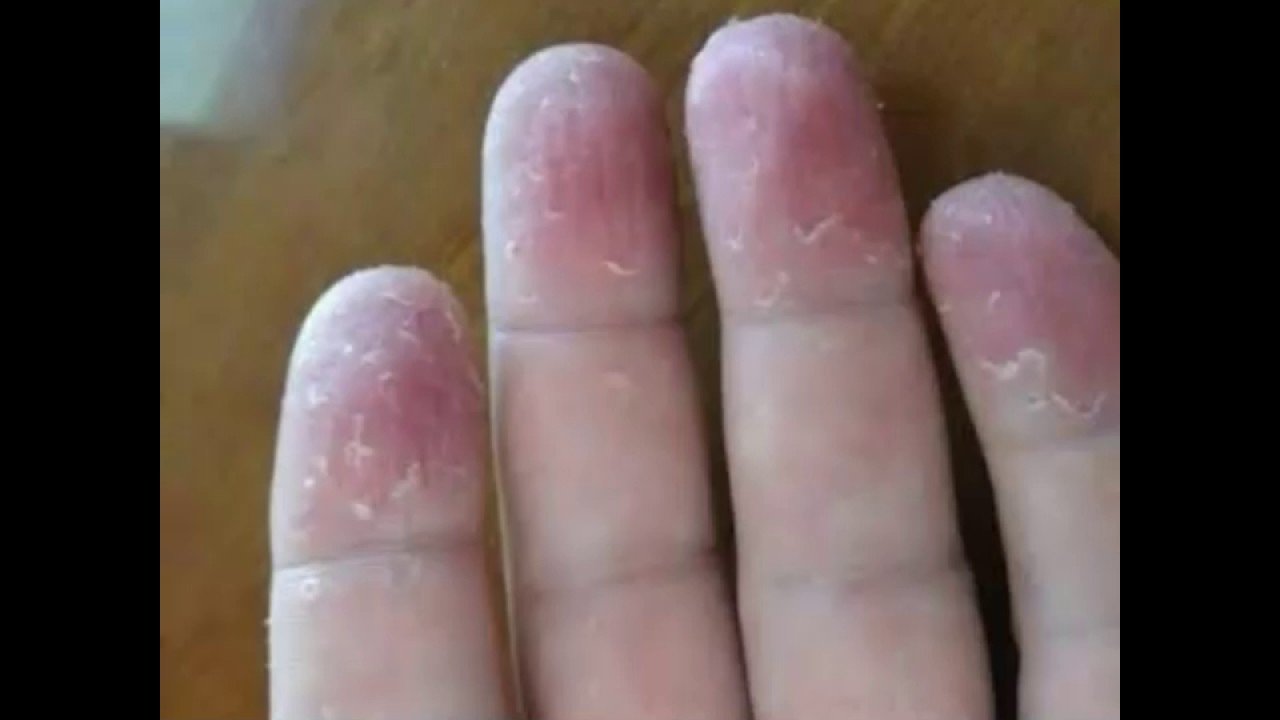 Eczema en las manos tratamiento