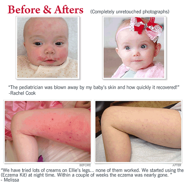 Eczema Experts Hydrocortisone Barrier Cream â Cheryl Lee MD Sensitive ...