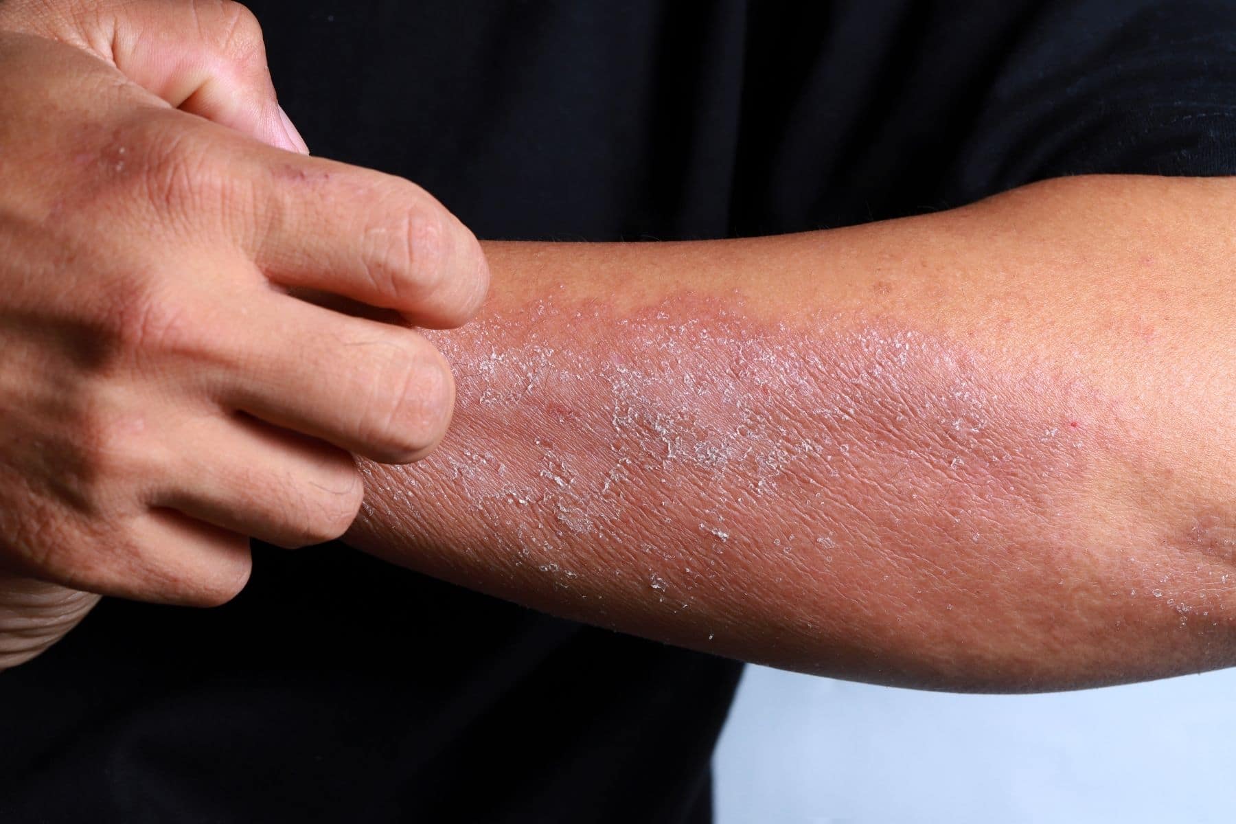 Eczema Explained: How To Break Free From Dry, Inflamed ...