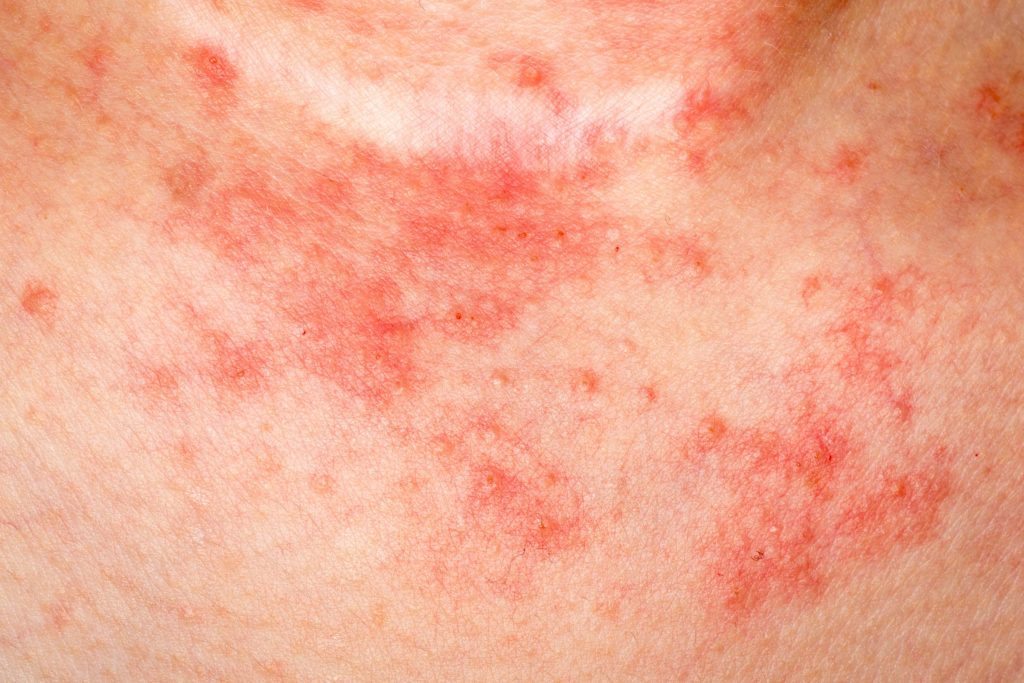 Eczema Facts: Things You Need To Know