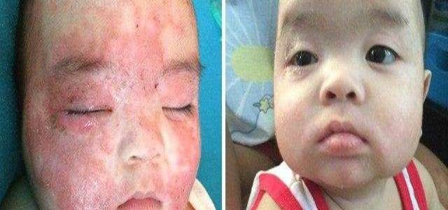 Eczema Flare Up Baby
