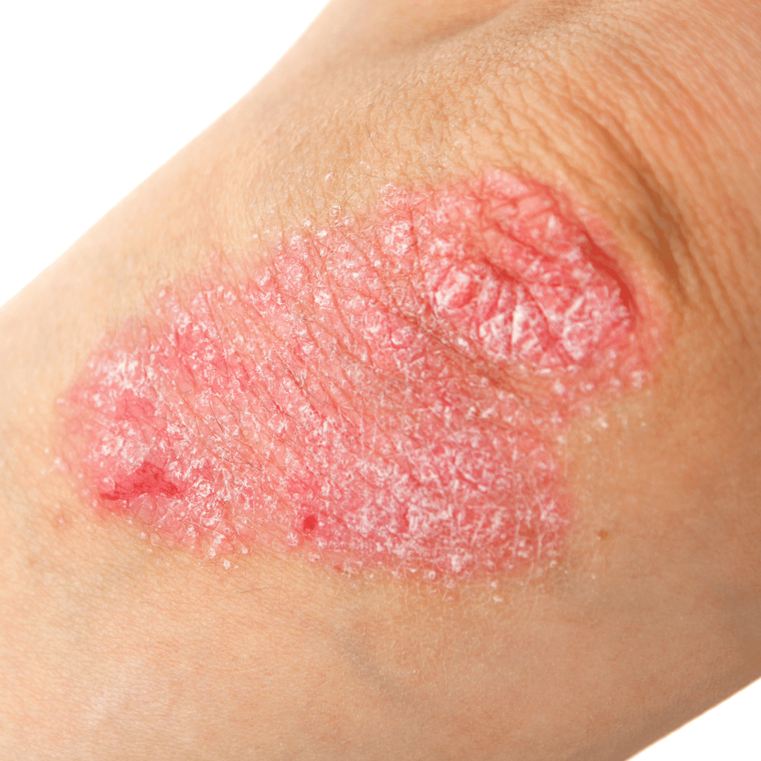 Eczema Flare