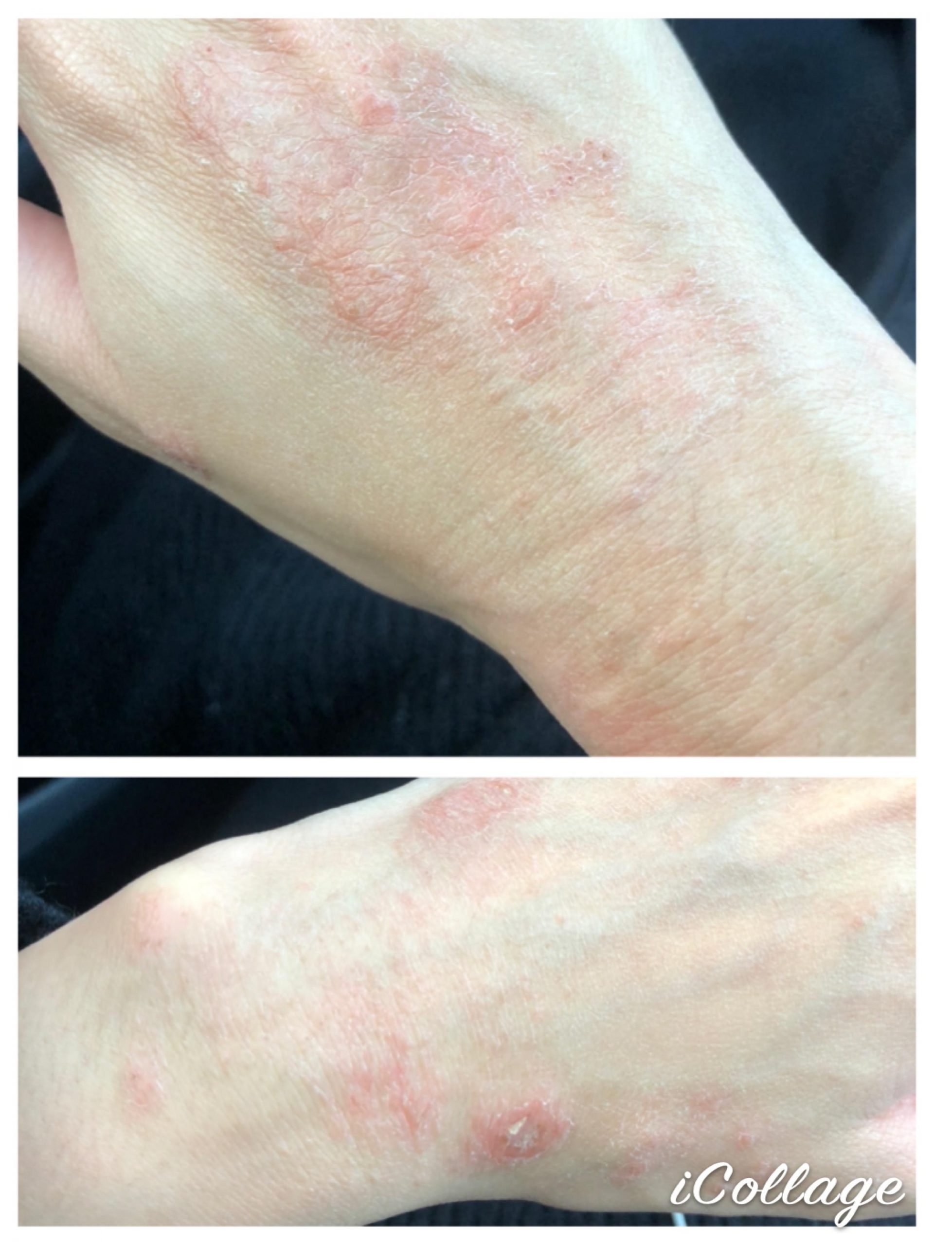 Eczema flaring up on hands like never before : Accutane