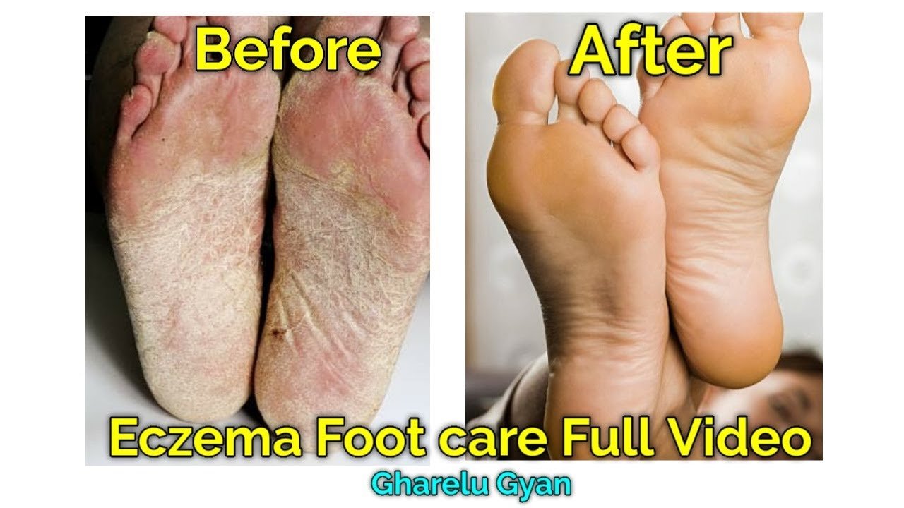 Eczema Foot care Full Video, Eczema    Eczema best ...