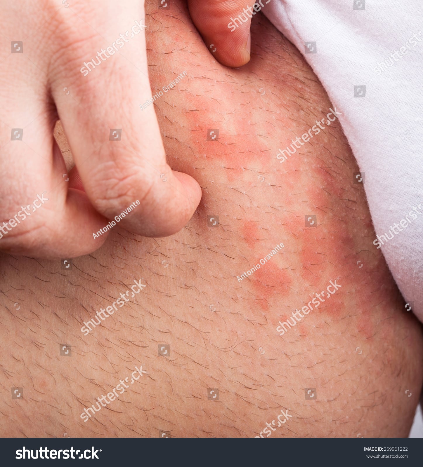Eczema Groin Atopic Dermatitis Symptom Of Skin Texture Stock Photo ...