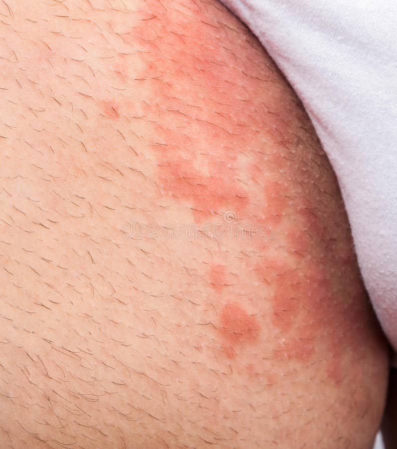 Eczema groin stock photo. Image of infection, itching