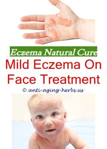 Eczema guidelines.Can eczema spread.What can clear up ...