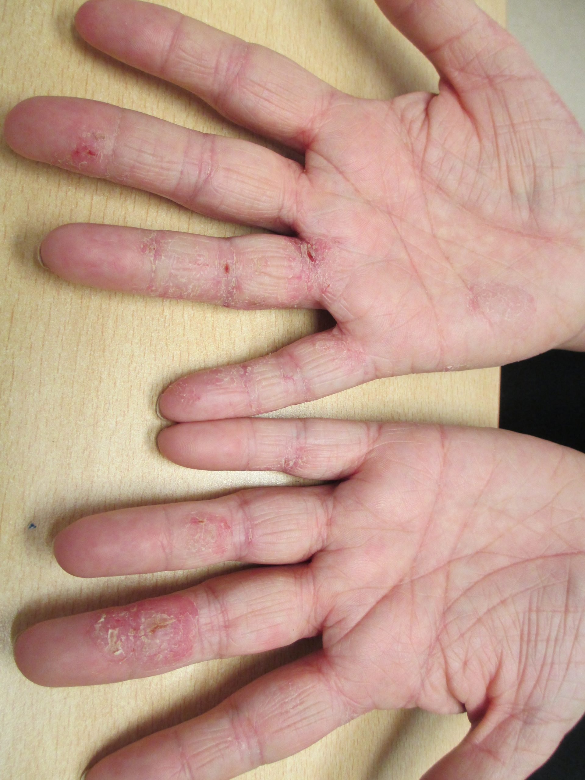 Eczema, Hand and Foot