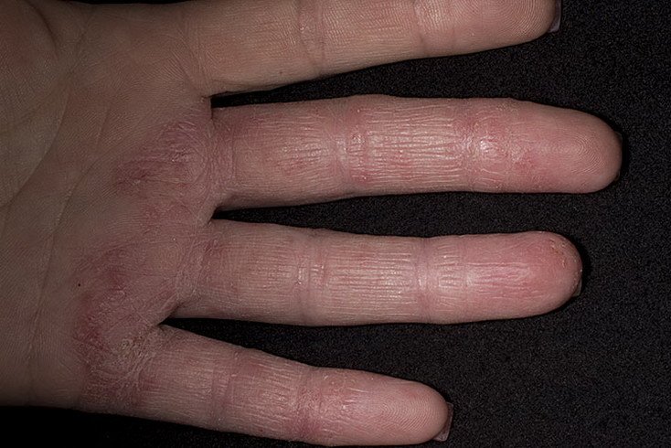 Eczema Hands Pictures  475 Photos &  Images / illnessee.com