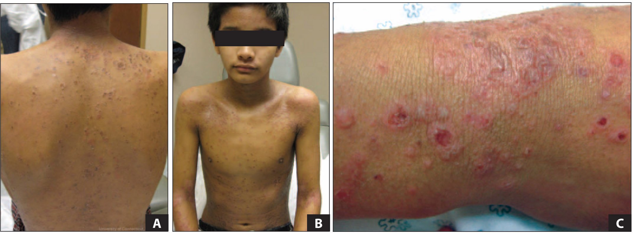 Eczema Herpeticum and Eczema Vaccinatum in Children