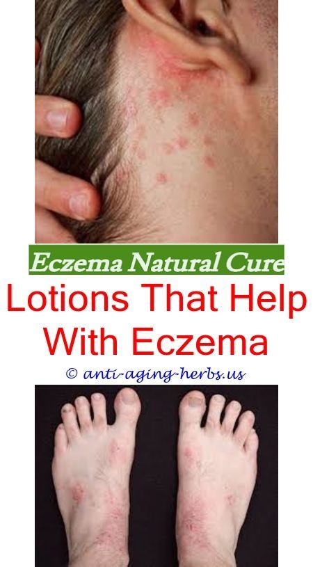 eczema herpeticum what does eczema look like pictures
