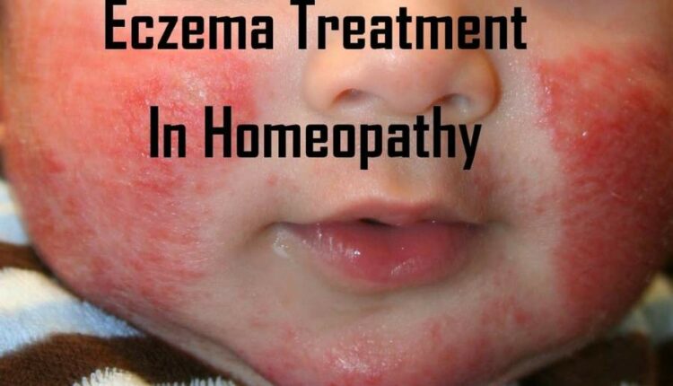 Eczema Homeopathic Treatment
