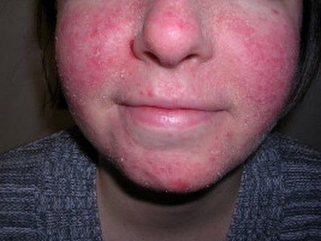 Eczema How To Treat When On Face
