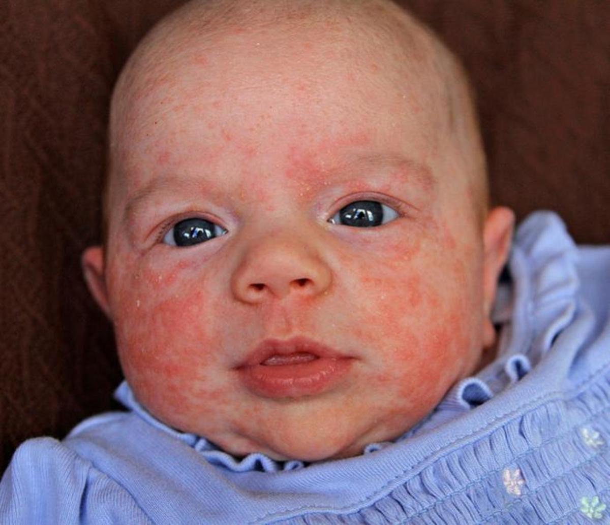 Eczema in Babies and Toddlers