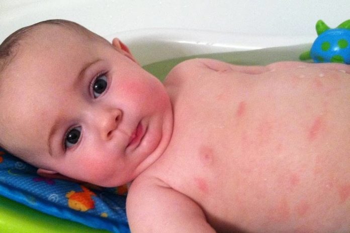 Eczema In Babies: Causes, Treatment, And Foods To Avoid