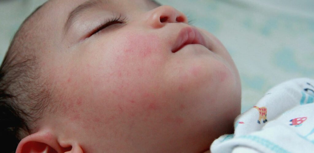 Eczema in Children â Overview, Tests, and Beneficial Foods ...