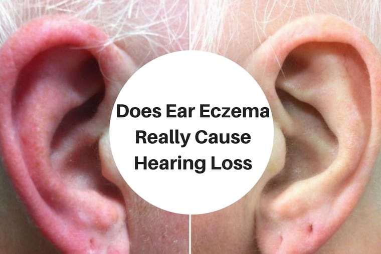 Eczema In Ears Pictures