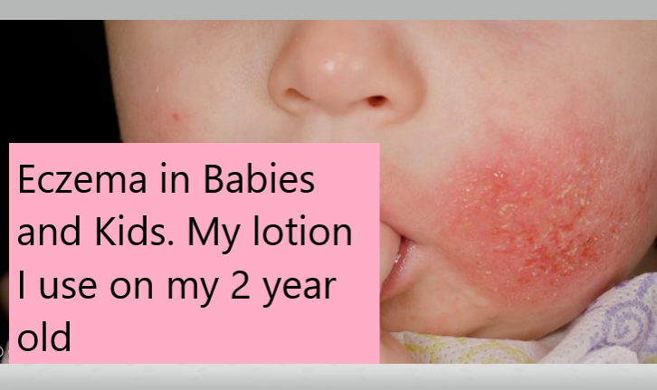 Eczema in Kids and Babies