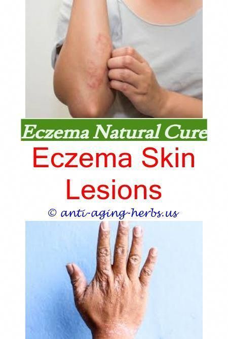 eczema inflammation causes eczema on my neck