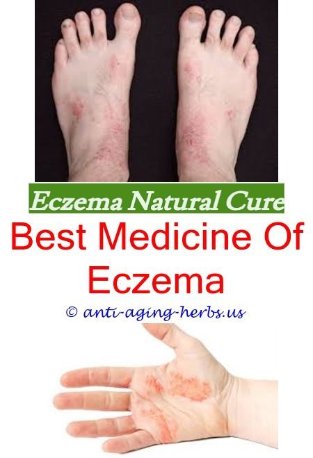eczema inflammation causes preventing eczema flare ups ...