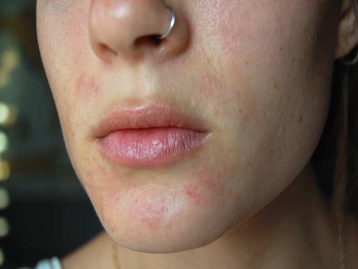Eczema Inside Legs Nose Pictures / Francegenweb Suggestion