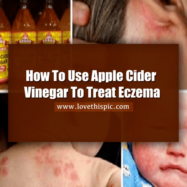 Eczema is a skin problem that makes skin areas irritated and inflamed ...
