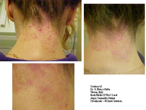 Eczema Laser Treatment
