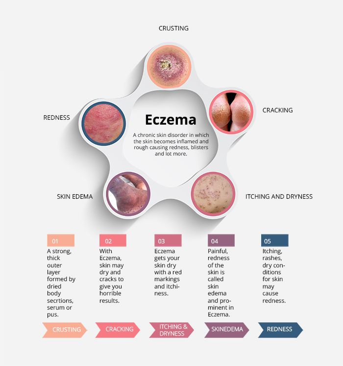 Eczema Living