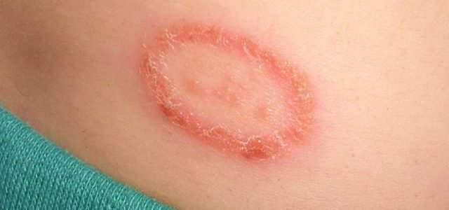 Eczema Look Like Ringworm
