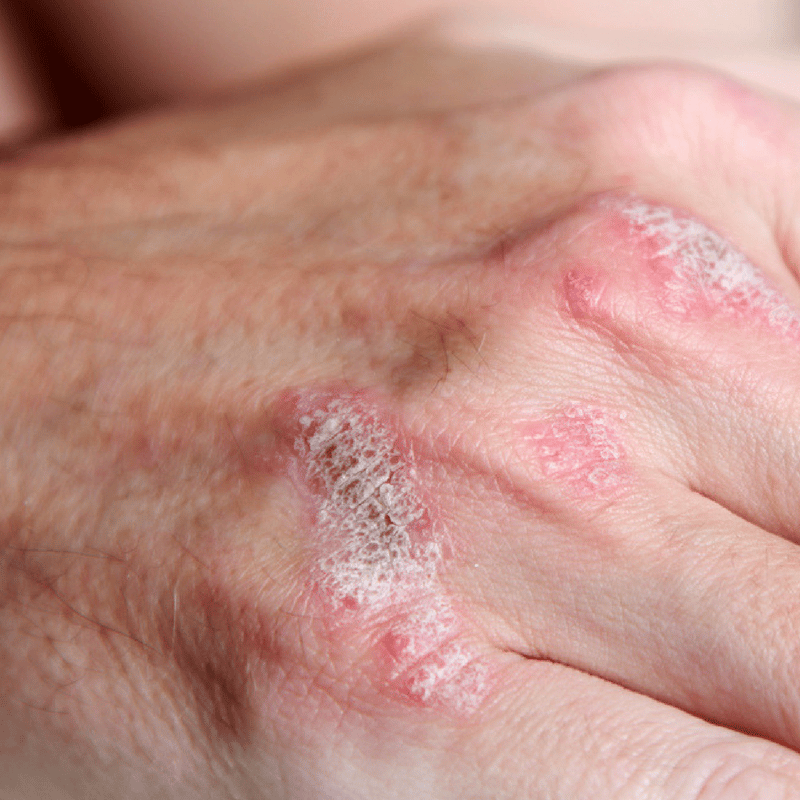 Eczema manifests itself in patches of dry skin that are often red ...