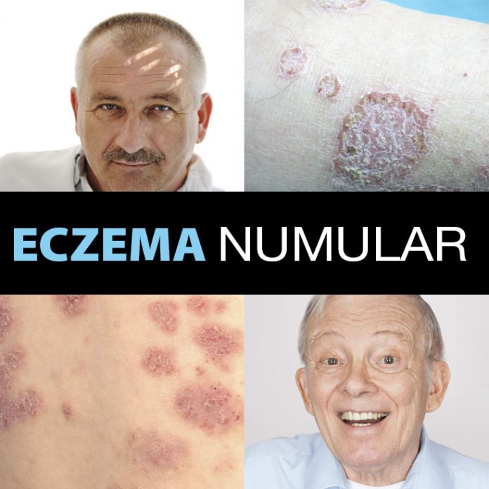 Eczema numular: causas, síntomas, diagnóstico y ...