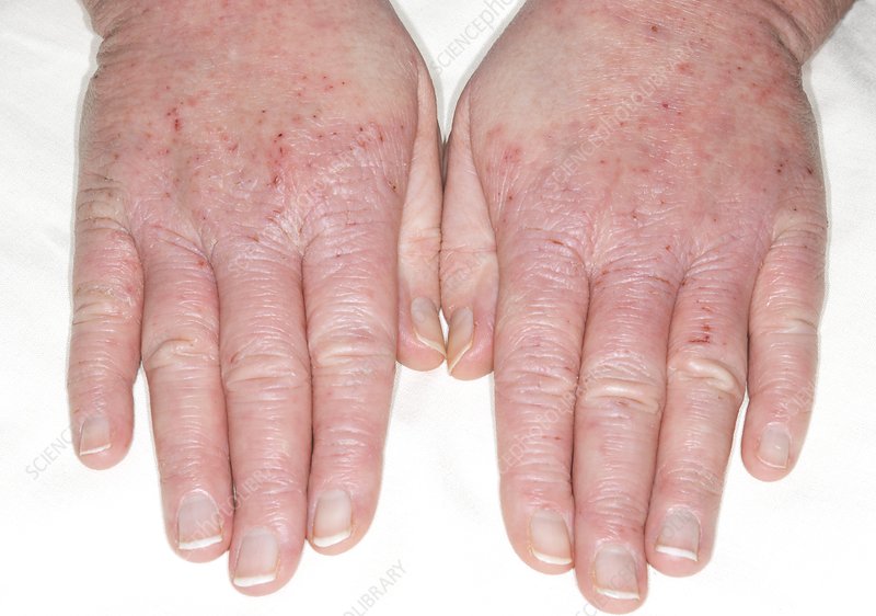 Eczema of the hands