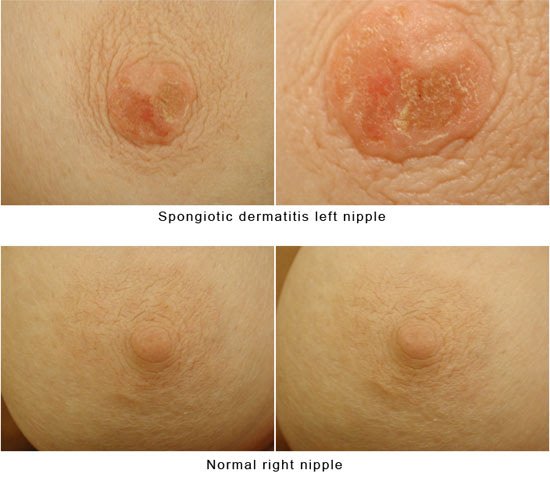 Eczema Of The Nipple Symptoms