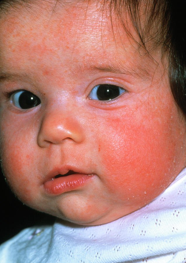 Eczema On Baby
