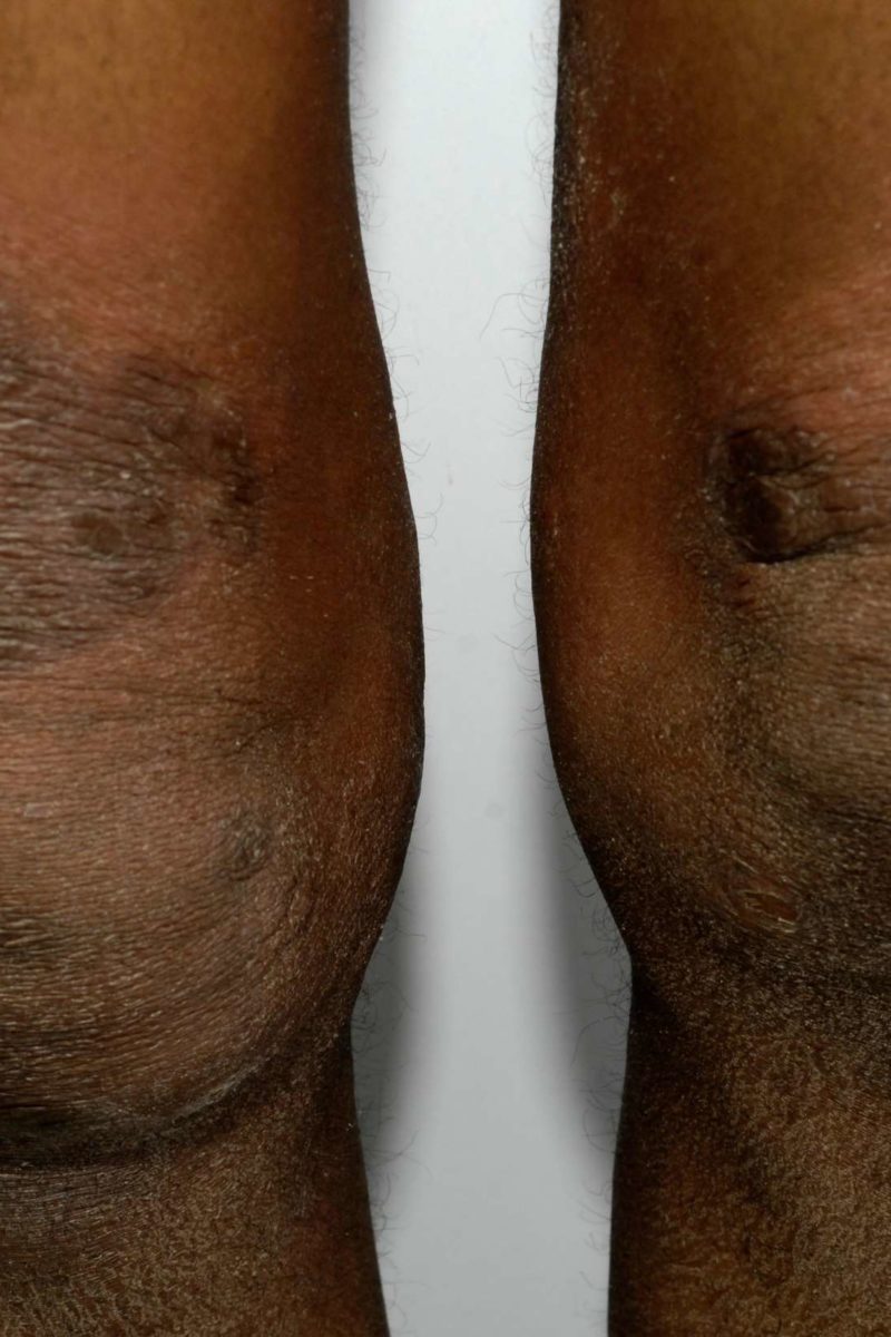 Eczema on black skin: Pictures, symptoms, and treatment