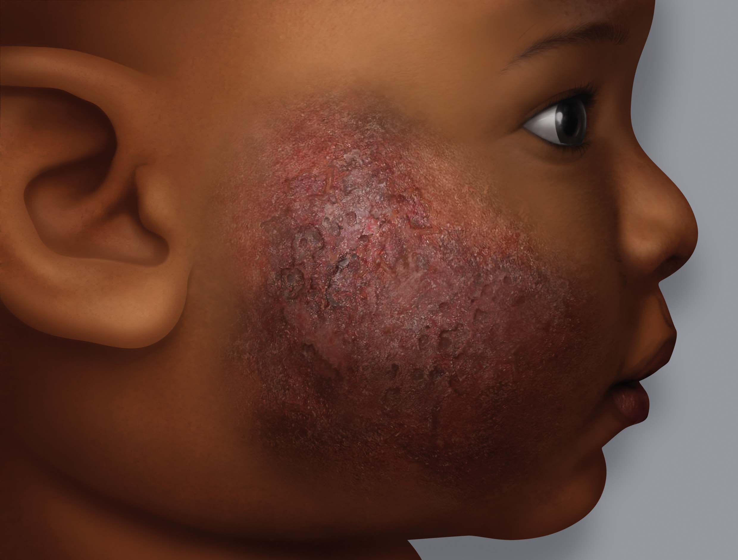 Eczema on dark skin