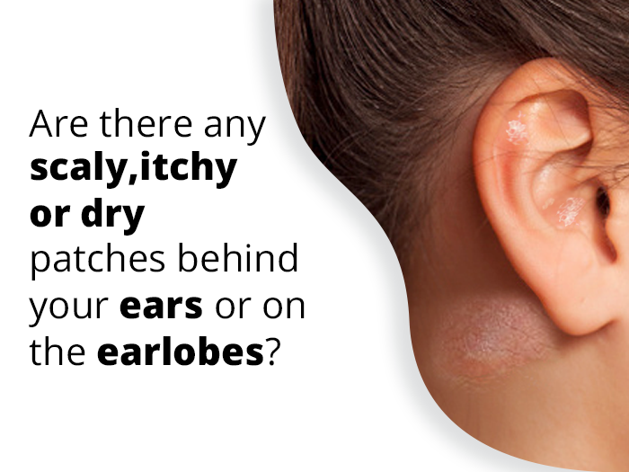Eczema on Ear â How to Get Rid of Itchy or Dry Ear Eczema ...