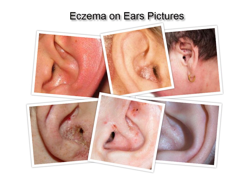 Eczema on Ear