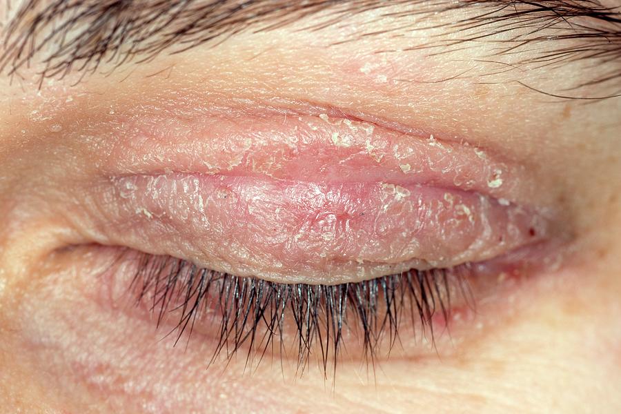 Eczema On Eyelid Photograph by Dr P. Marazzi/science Photo ...